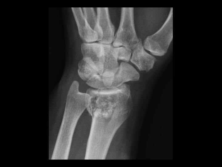 Figure 2 for case enchondroma ( RID4128 )